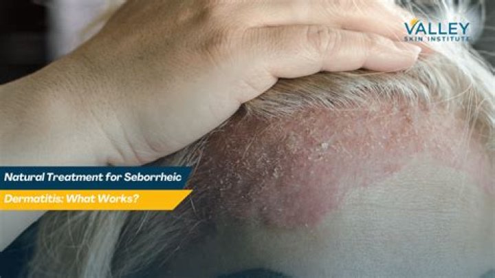 Unlock The Power Of Home Treatment For Seborrheic Keratosis